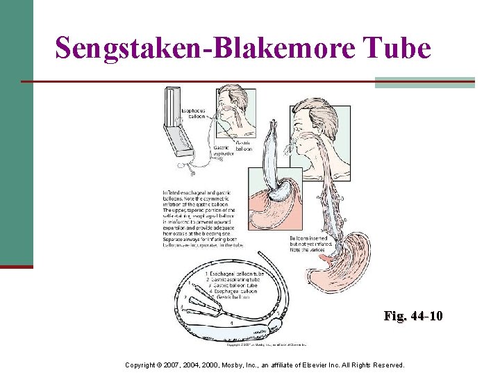 Sengstaken-Blakemore Tube Fig. 44 -10 Copyright © 2007, 2004, 2000, Mosby, Inc. , an