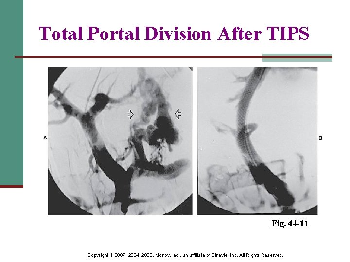 Total Portal Division After TIPS Fig. 44 -11 Copyright © 2007, 2004, 2000, Mosby,