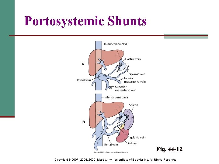 Portosystemic Shunts Fig. 44 -12 Copyright © 2007, 2004, 2000, Mosby, Inc. , an