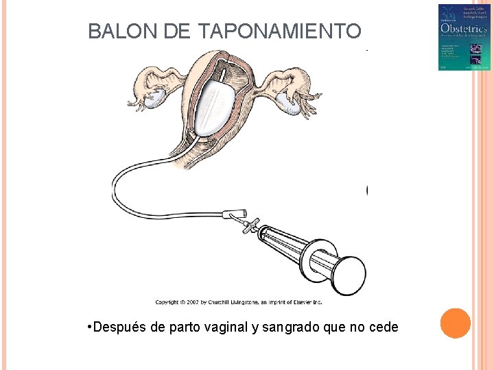 BALON DE TAPONAMIENTO • Después de parto vaginal y sangrado que no cede 