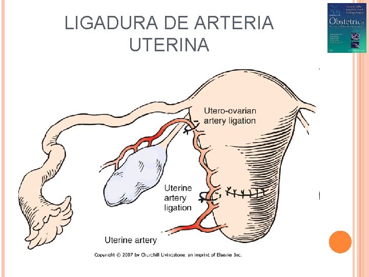 LIGADURA DE ARTERIA UTERINA 