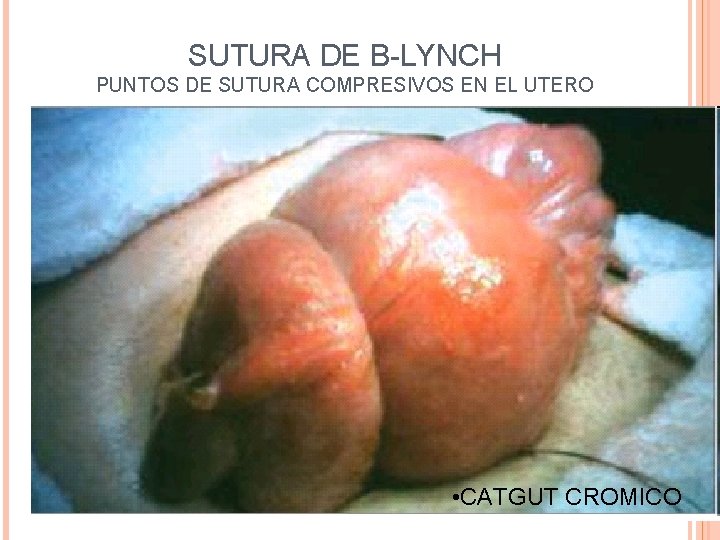 SUTURA DE B-LYNCH PUNTOS DE SUTURA COMPRESIVOS EN EL UTERO • CATGUT CROMICO 