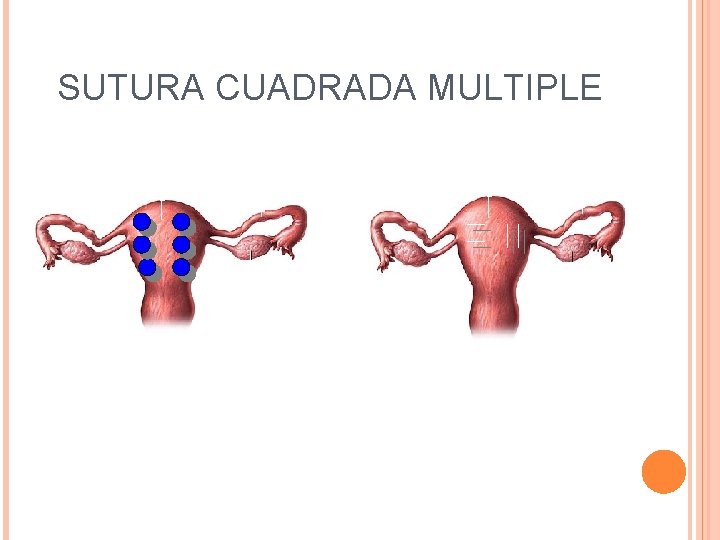 SUTURA CUADRADA MULTIPLE 
