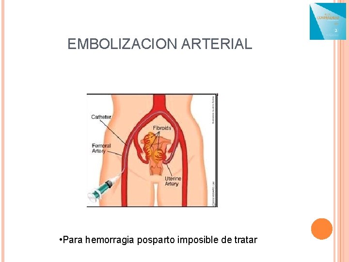 EMBOLIZACION ARTERIAL • Para hemorragia posparto imposible de tratar 