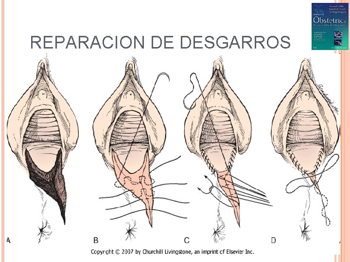 REPARACION DE DESGARROS 