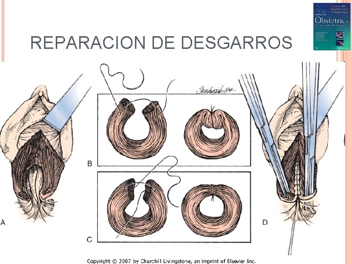 REPARACION DE DESGARROS 