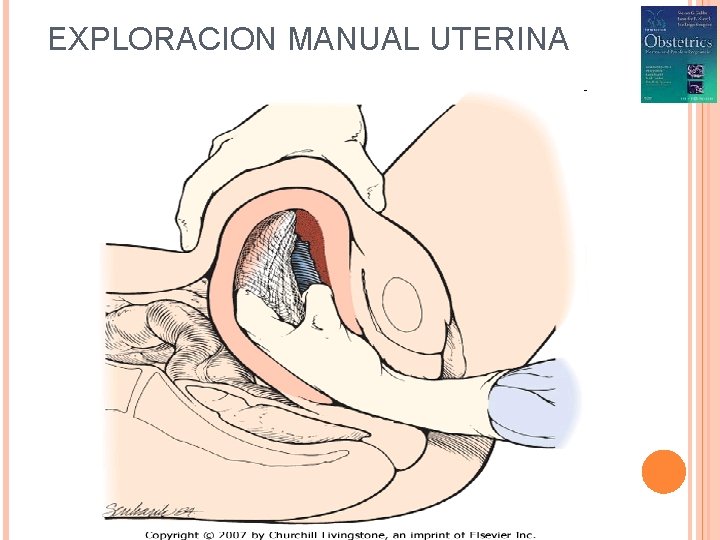 EXPLORACION MANUAL UTERINA 