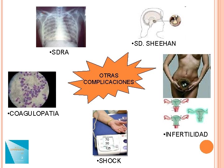  • SD. SHEEHAN • SDRA OTRAS COMPLICACIONES • COAGULOPATIA 70 30 125 •