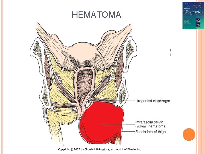 HEMATOMA 