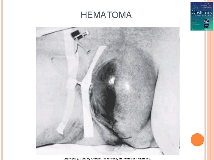 HEMATOMA 