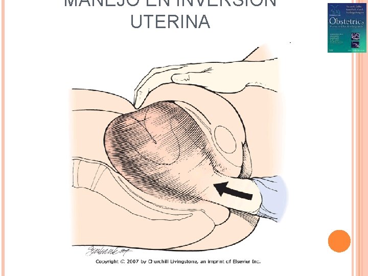 MANEJO EN INVERSION UTERINA 