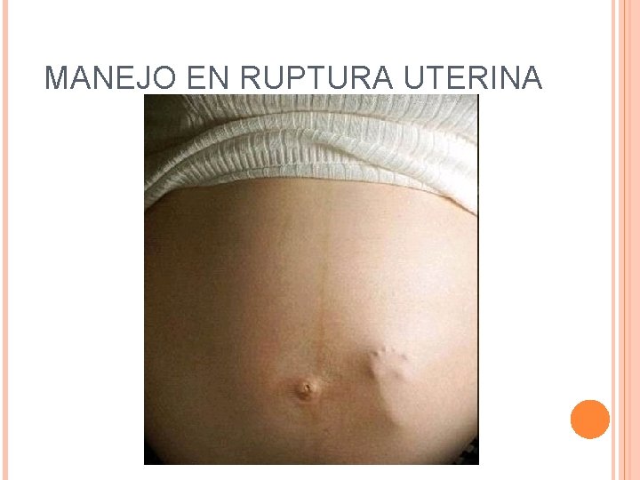 MANEJO EN RUPTURA UTERINA 