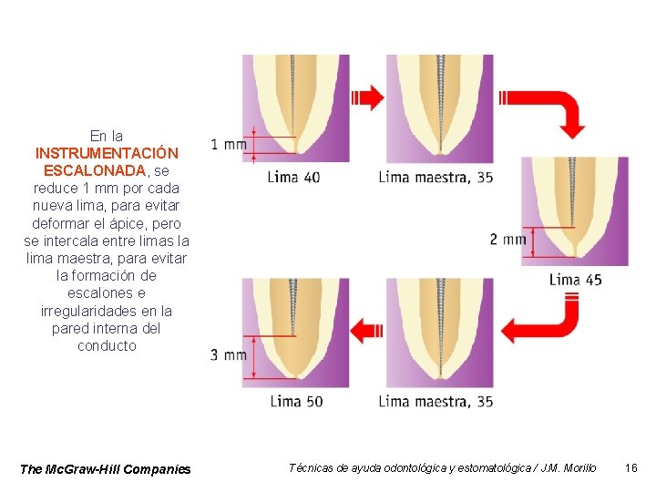 En la INSTRUMENTACIÓN ESCALONADA, se reduce 1 mm por cada nueva lima, para evitar