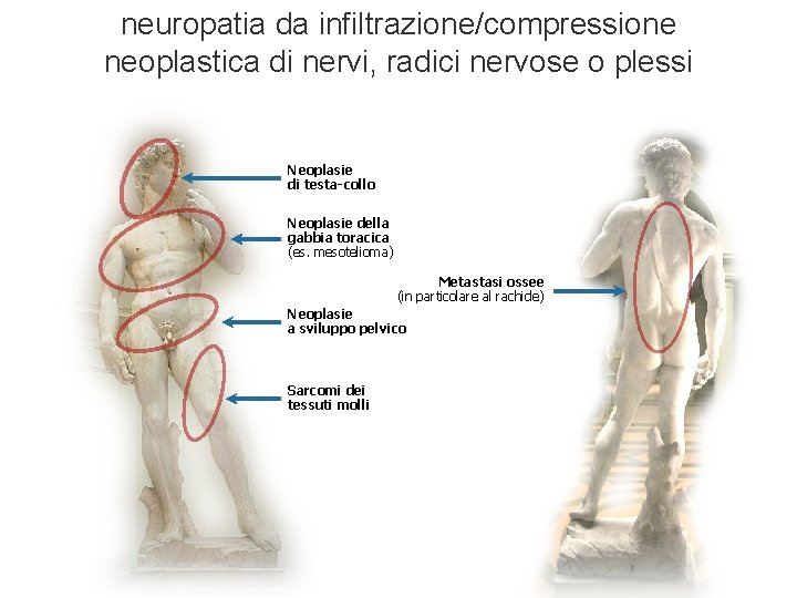 neuropatia da infiltrazione/compressione neoplastica di nervi, radici nervose o plessi Neoplasie di testa-collo Neoplasie neuropatia da infiltrazione/compressione neoplastica di nervi, radici nervose o plessi Neoplasie di testa-collo Neoplasie