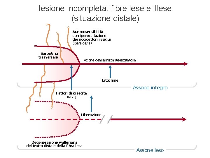 lesione incompleta: fibre lese e illese (situazione distale) Adrenosensibilità con ipereccitazione dei nocicettori residui lesione incompleta: fibre lese e illese (situazione distale) Adrenosensibilità con ipereccitazione dei nocicettori residui
