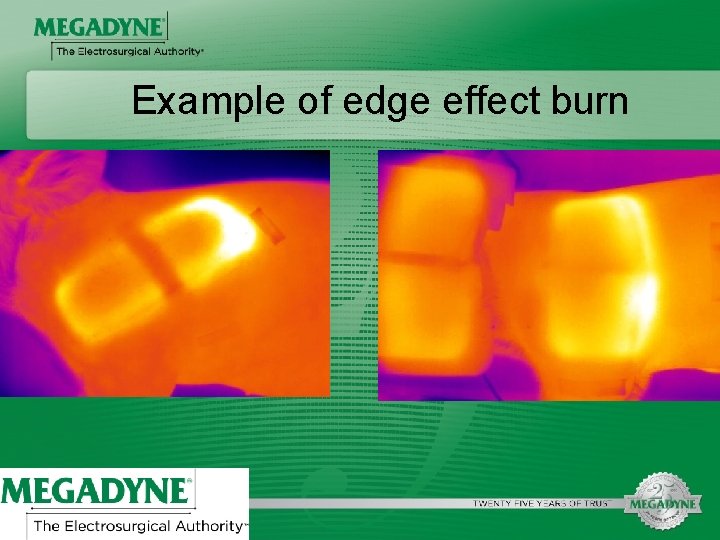 Example of edge effect burn 