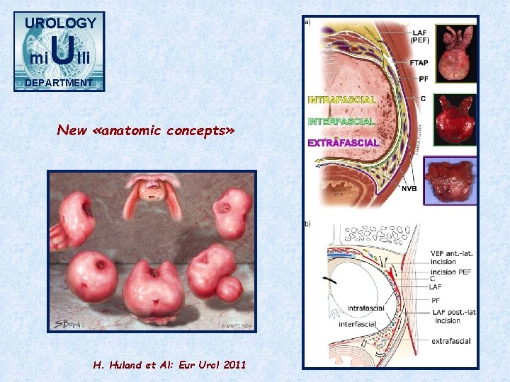 UROLOGY mi Ulli DEPARTMENT New «anatomic concepts» H. Huland et Al: Eur Urol 2011
