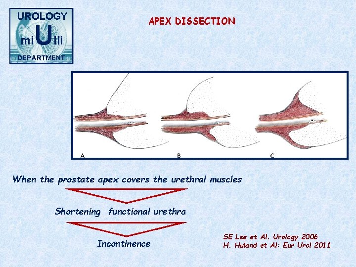 UROLOGY mi Ulli APEX DISSECTION DEPARTMENT When the prostate apex covers the urethral muscles