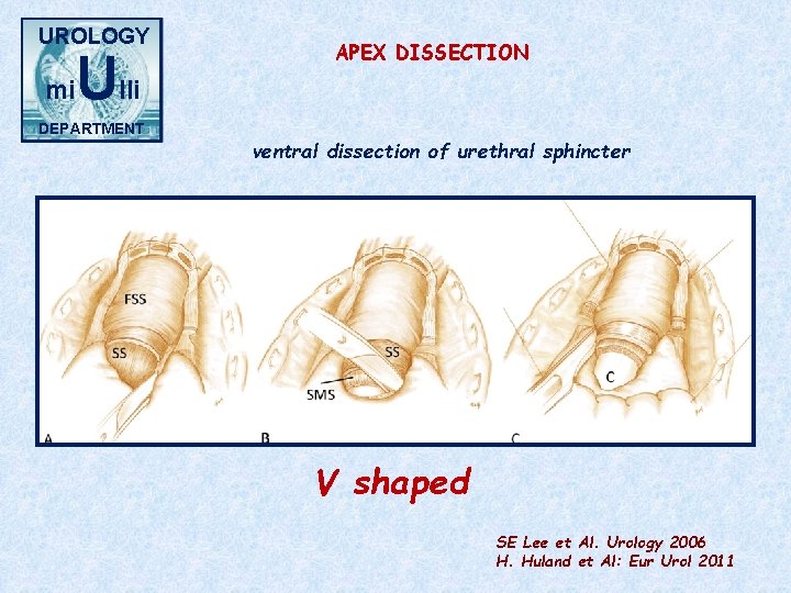 UROLOGY mi Ulli DEPARTMENT APEX DISSECTION ventral dissection of urethral sphincter V shaped SE