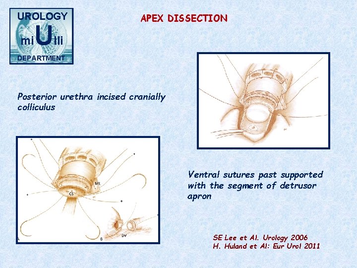 UROLOGY mi Ulli APEX DISSECTION DEPARTMENT Posterior urethra incised cranially colliculus Ventral sutures past