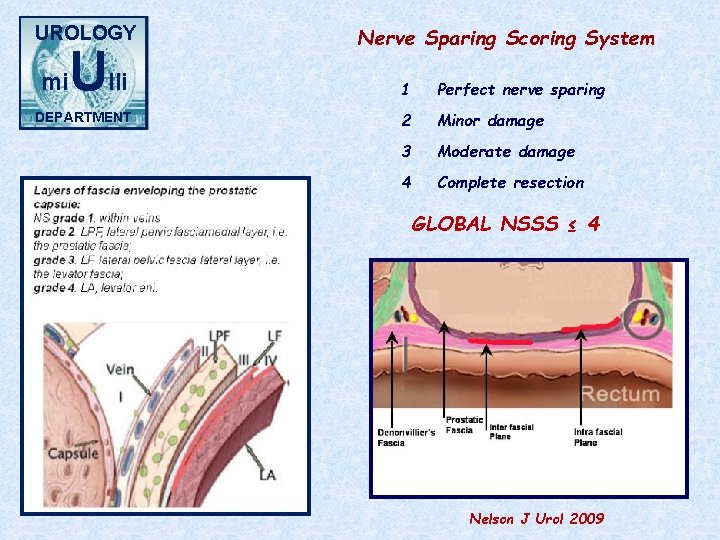 UROLOGY mi Ulli DEPARTMENT Nerve Sparing Scoring System 1 Perfect nerve sparing 2 Minor