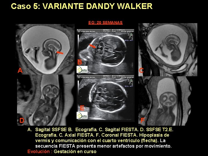 Caso 5: VARIANTE DANDY WALKER EG: 20 SEMANAS B A C E D F