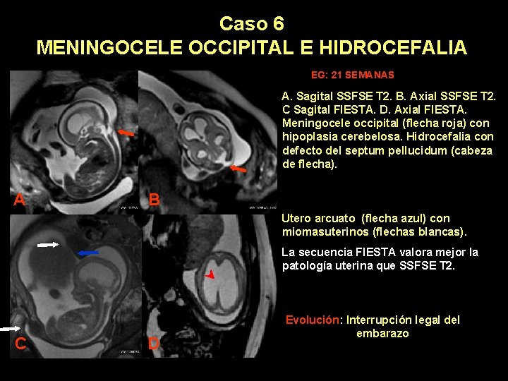 Caso 6 MENINGOCELE OCCIPITAL E HIDROCEFALIA EG: 21 SEMANAS A. Sagital SSFSE T 2.