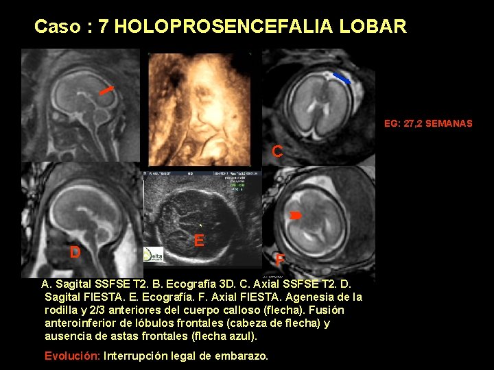 Caso : 7 HOLOPROSENCEFALIA LOBAR EG: 27, 2 SEMANAS A D B C E