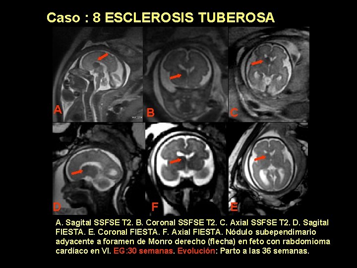 Caso : 8 ESCLEROSIS TUBEROSA A B C D F E A. Sagital SSFSE