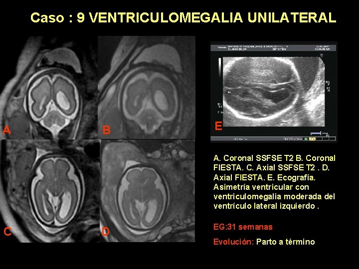 Caso : 9 VENTRICULOMEGALIA UNILATERAL A B E A. Coronal SSFSE T 2 B.