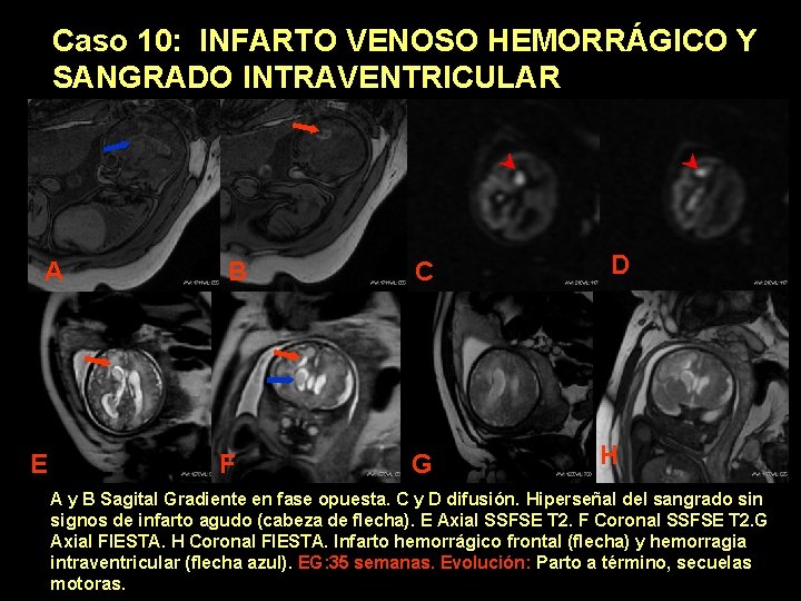 Caso 10: INFARTO VENOSO HEMORRÁGICO Y SANGRADO INTRAVENTRICULAR A E B F C G