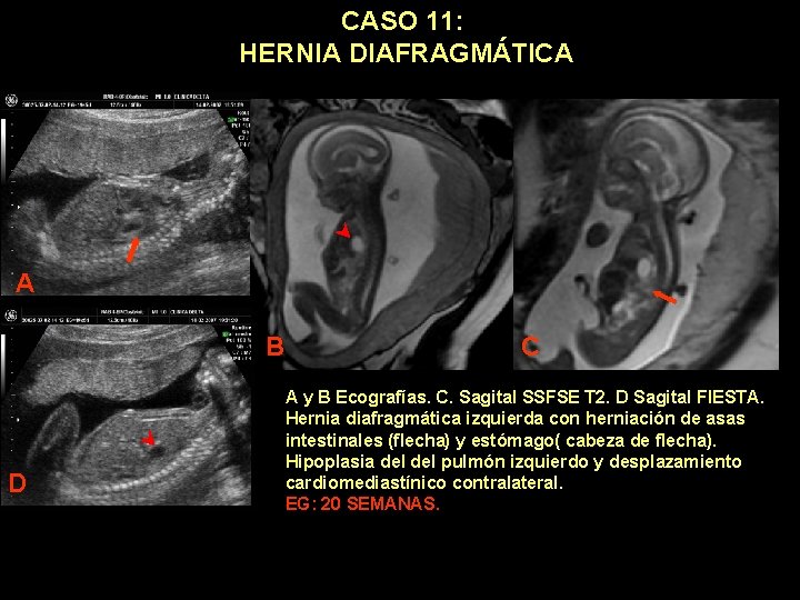 CASO 11: HERNIA DIAFRAGMÁTICA A B D C A y B Ecografías. C. Sagital