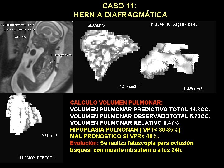 CASO 11: HERNIA DIAFRAGMÁTICA CALCULO VOLUMEN PULMONAR: VOLUMEN PULMONAR PREDICTIVO TOTAL 14, 8 CC.