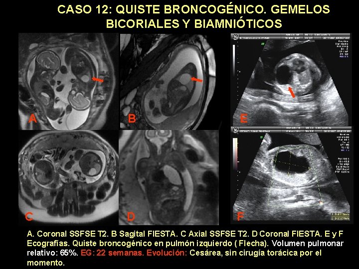 CASO 12: QUISTE BRONCOGÉNICO. GEMELOS BICORIALES Y BIAMNIÓTICOS A B E C D F