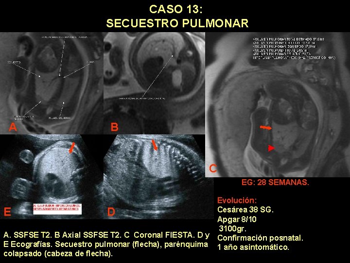 CASO 13: SECUESTRO PULMONAR A B C EG: 28 SEMANAS. Evolución: Cesárea 38 SG.