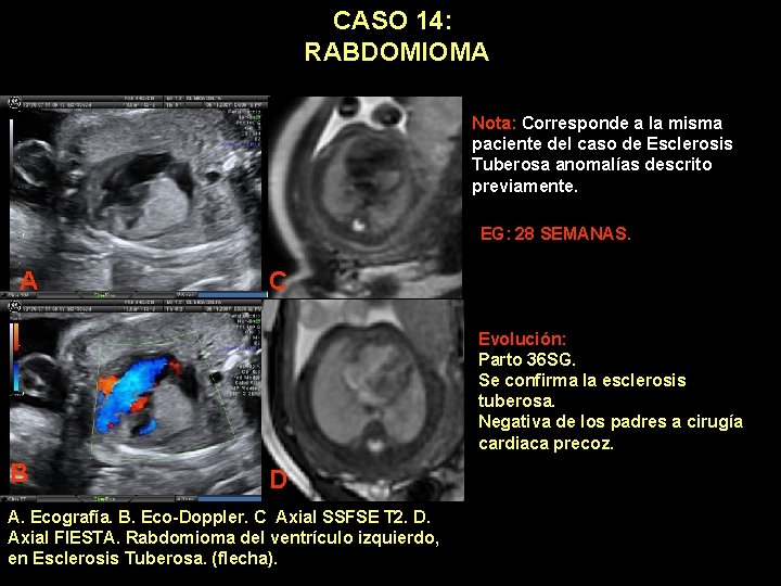 CASO 14: RABDOMIOMA Nota: Corresponde a la misma paciente del caso de Esclerosis Tuberosa