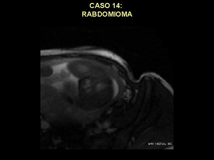 CASO 14: RABDOMIOMA 