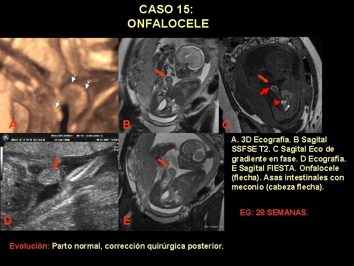 CASO 15: ONFALOCELE A B C A. 3 D Ecografía. B Sagital SSFSE T