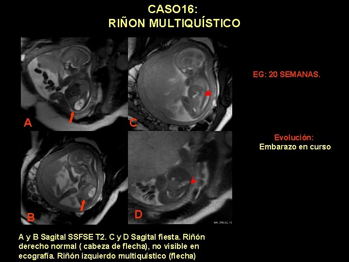 CASO 16: RIÑON MULTIQUÍSTICO EG: 20 SEMANAS. A C Evolución: Embarazo en curso B