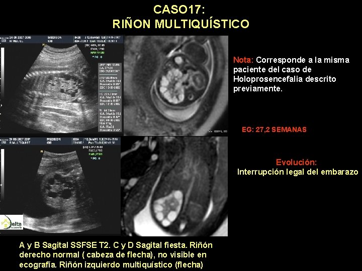 CASO 17: RIÑON MULTIQUÍSTICO Nota: Corresponde a la misma paciente del caso de Holoprosencefalia