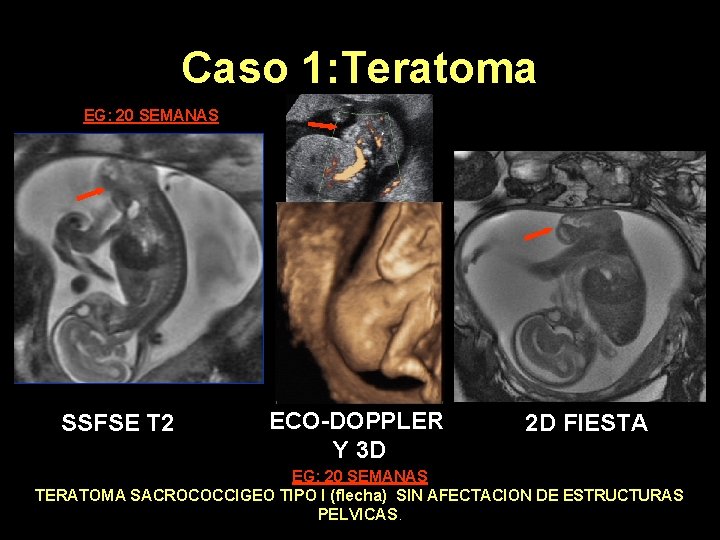 Caso 1: Teratoma EG: 20 SEMANAS SSFSE T 2 ECO-DOPPLER Y 3 D 2