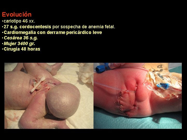 Evolución • cariotipo 46 xx. • 27 s. g. cordocentesis por sospecha de anemia