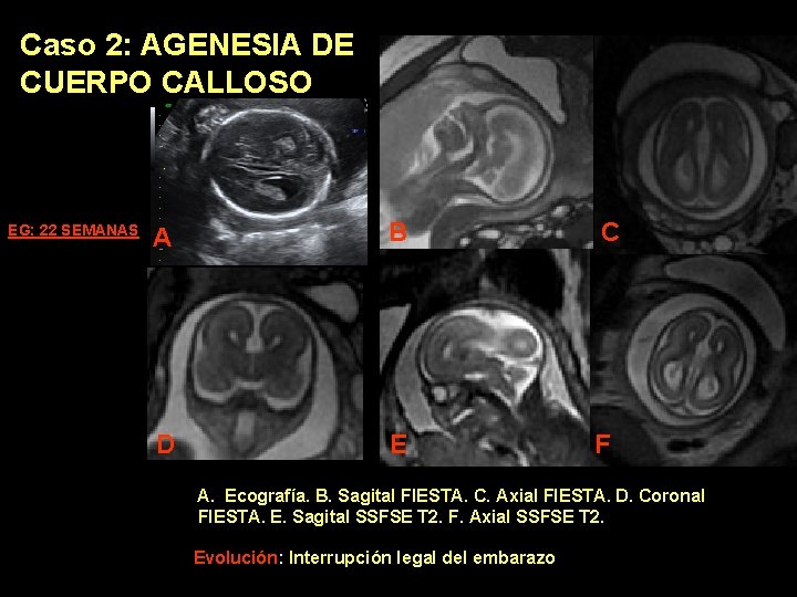 Caso 2: AGENESIA DE CUERPO CALLOSO EG: 22 SEMANAS A B C D E