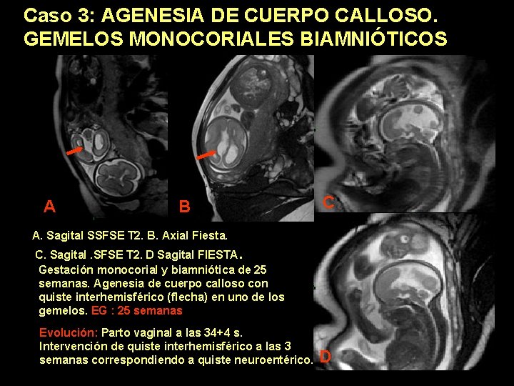 Caso 3: AGENESIA DE CUERPO CALLOSO. GEMELOS MONOCORIALES BIAMNIÓTICOS A B C A. Sagital