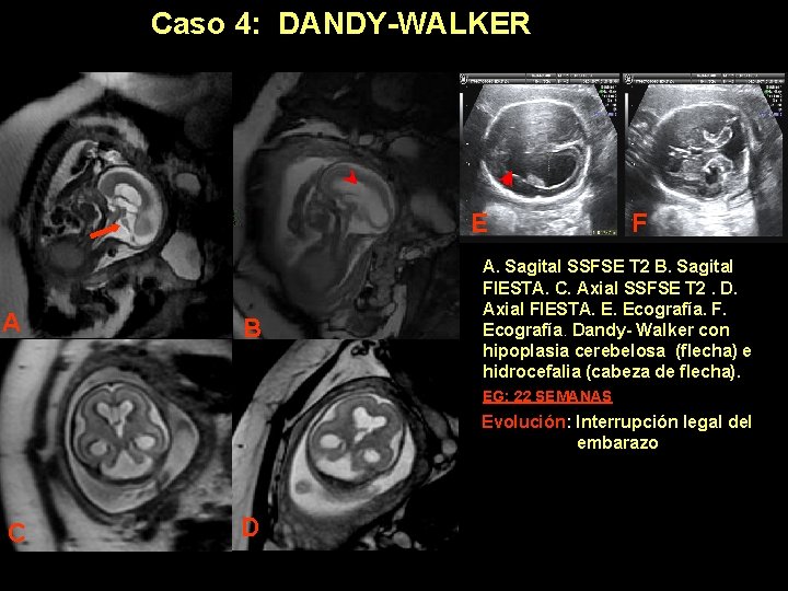 Caso 4: DANDY-WALKER E A B F A. Sagital SSFSE T 2 B. Sagital