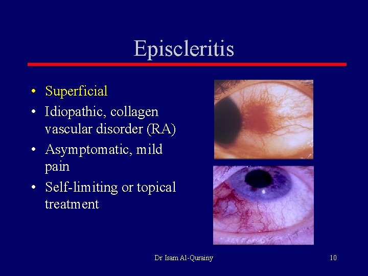 Episcleritis • Superficial • Idiopathic, collagen vascular disorder (RA) • Asymptomatic, mild pain •