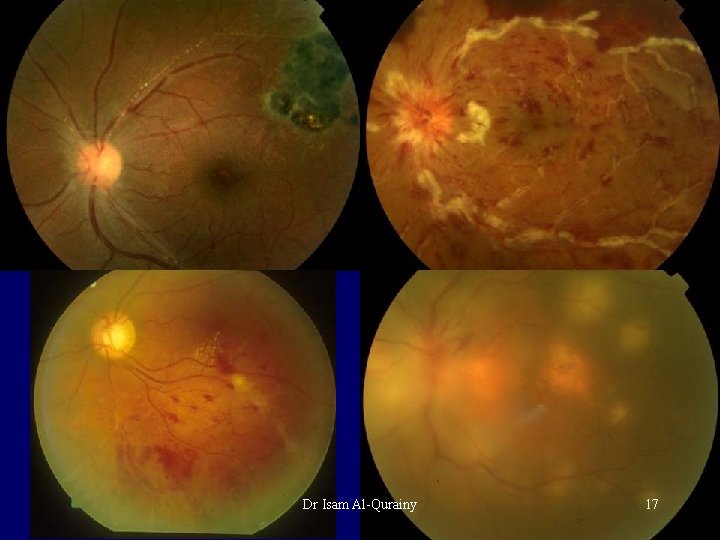 Dr Isam Al-Qurainy 17 Dr Isam Al-Qurainy 17