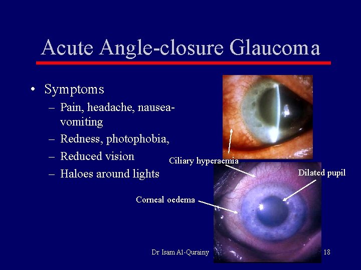 Acute Angle-closure Glaucoma • Symptoms – Pain, headache, nauseavomiting – Redness, photophobia, – Reduced