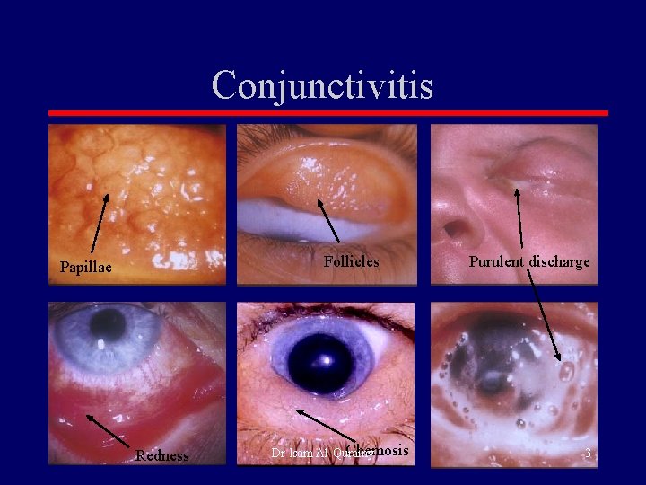 Conjunctivitis Follicles Papillae Redness Chemosis Dr Isam Al-Qurainy Purulent discharge 3 