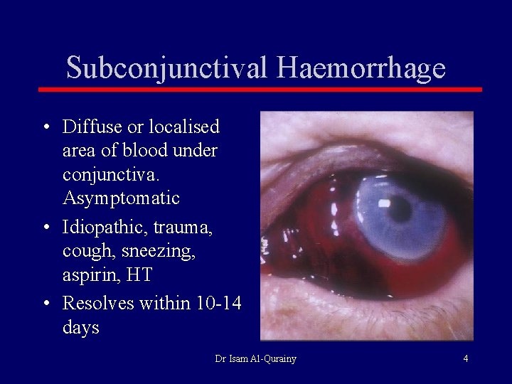 Subconjunctival Haemorrhage • Diffuse or localised area of blood under conjunctiva. Asymptomatic • Idiopathic,